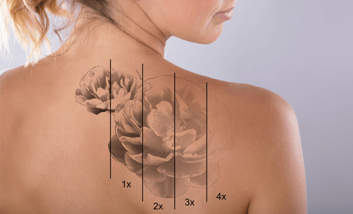 How Many Laser Tattoo Removal Treatments Do You Need?
